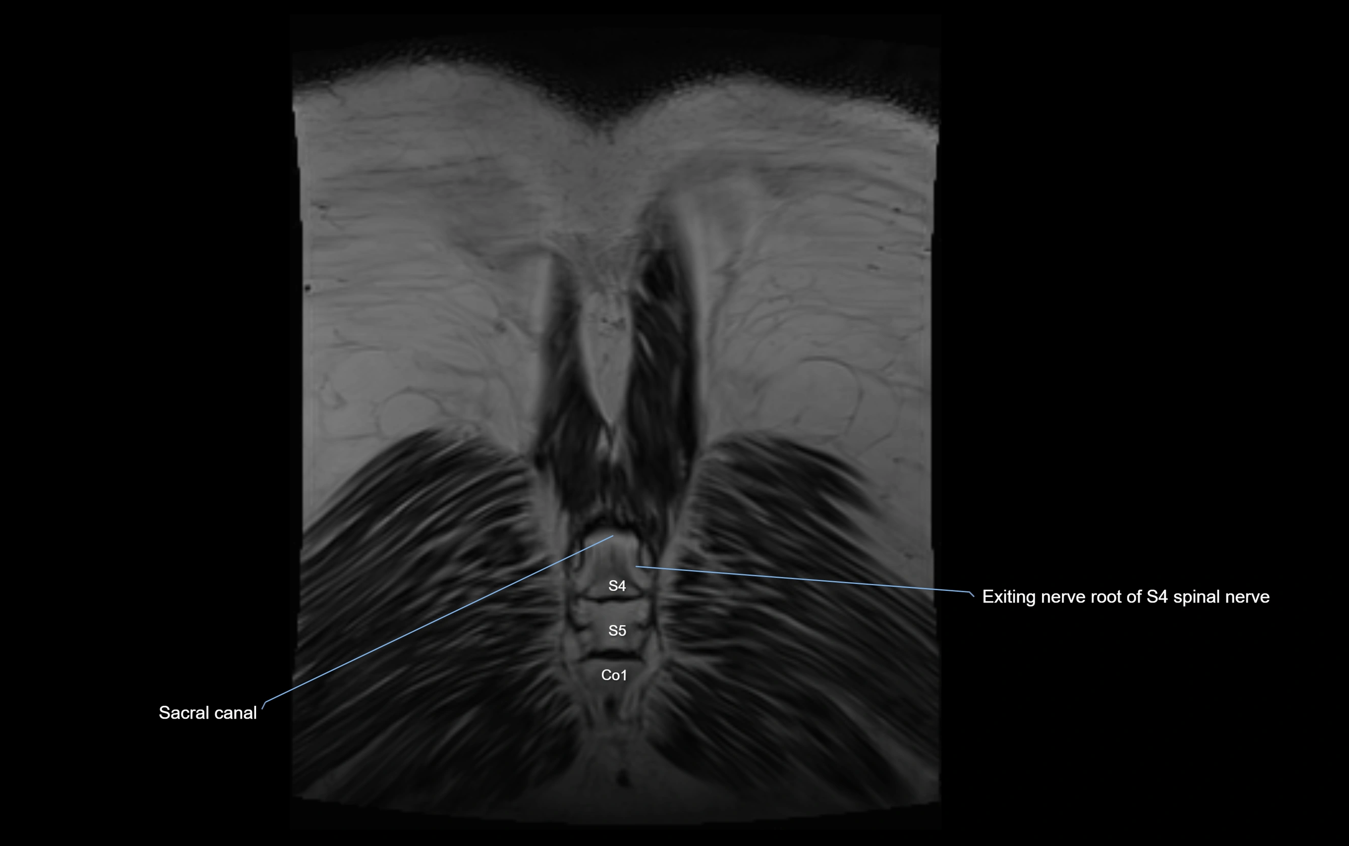 MR lumbosacral plexus cross sectional anatomy 3T  radiology  image-img-09001-00084.webp